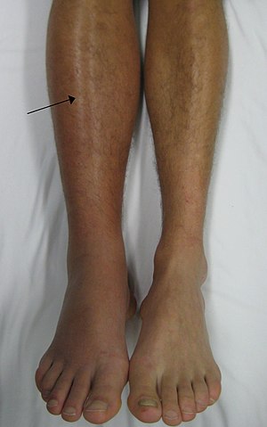 A person's legs annotated with an arrow pointing to signs of DVT.