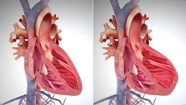 Enlargement of the left ventricle.