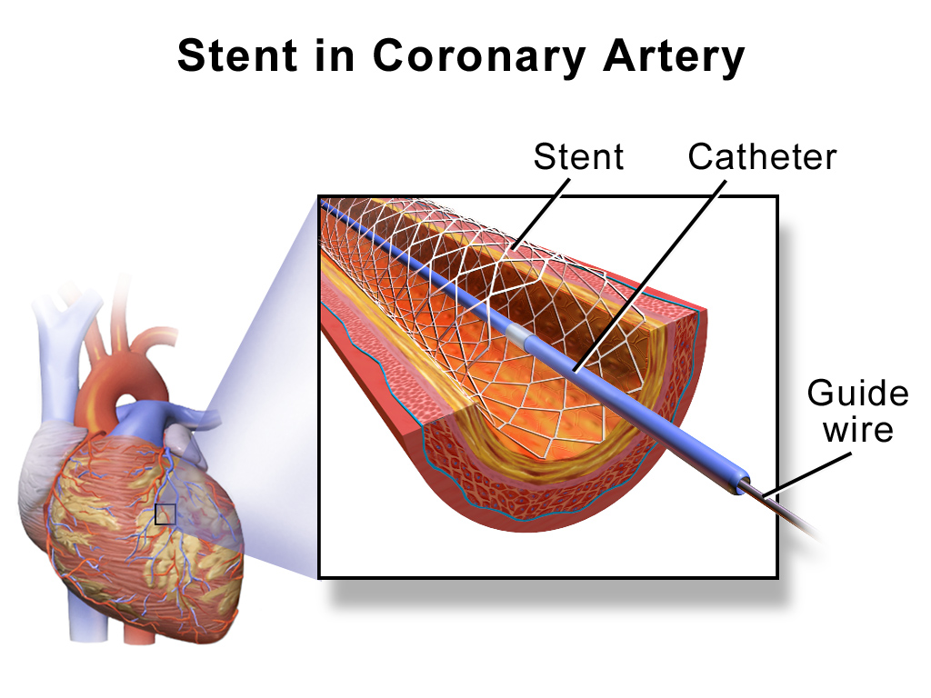 Illustration of heart with zoomed view of artery with a stent.