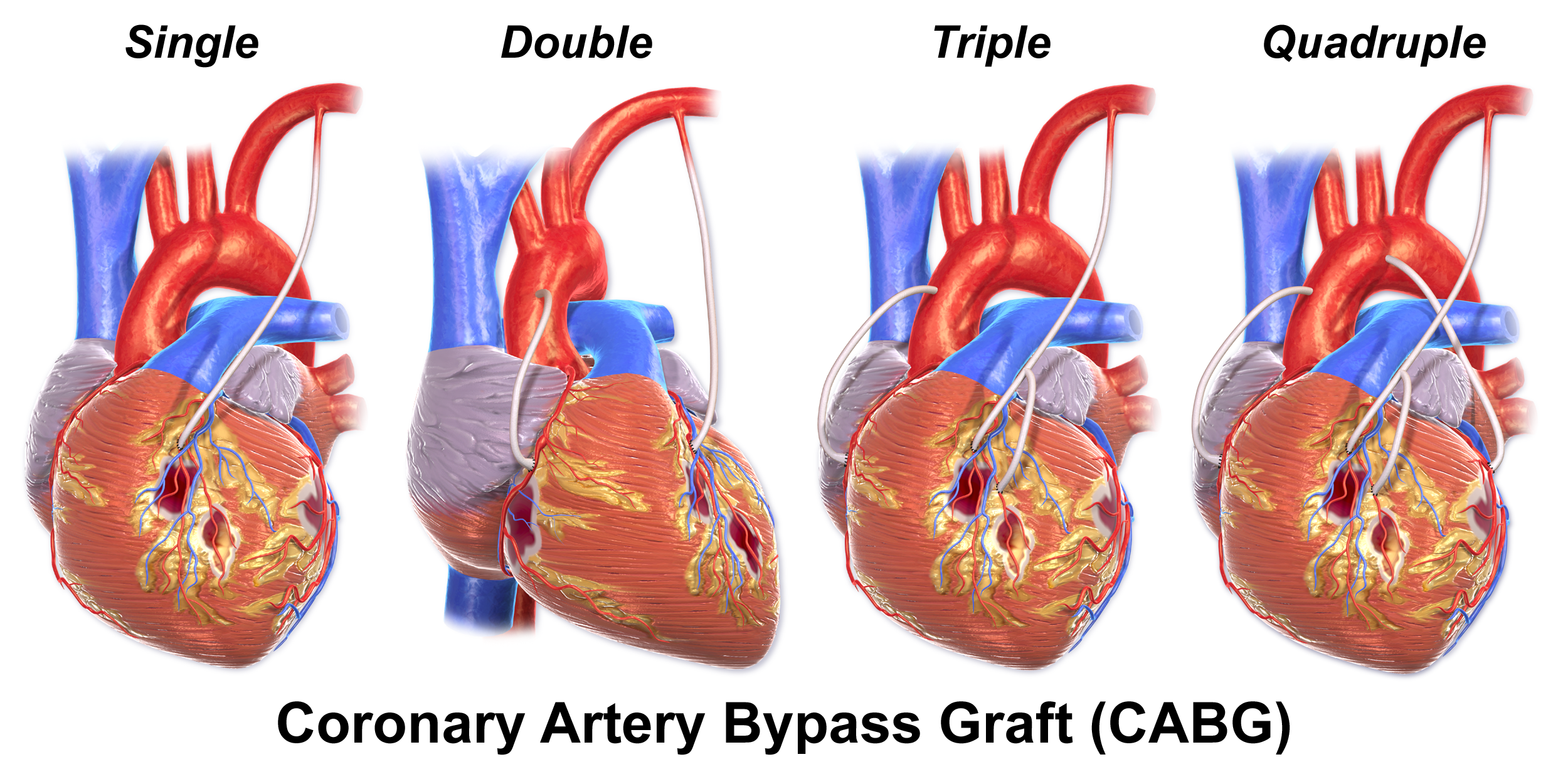 Four illustrations include single, double, triple and quadruple bypass grafts.