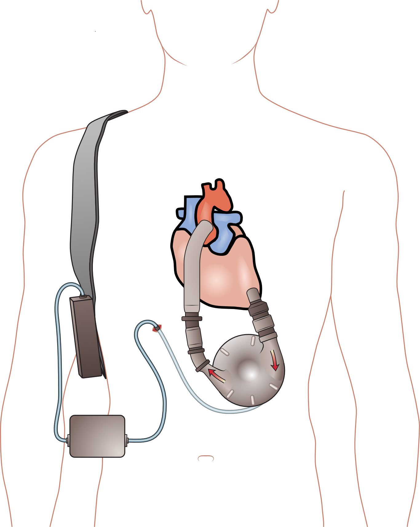 Illustration of Ventricular Assistive Device shows how it's worn and how it connects to the heart.