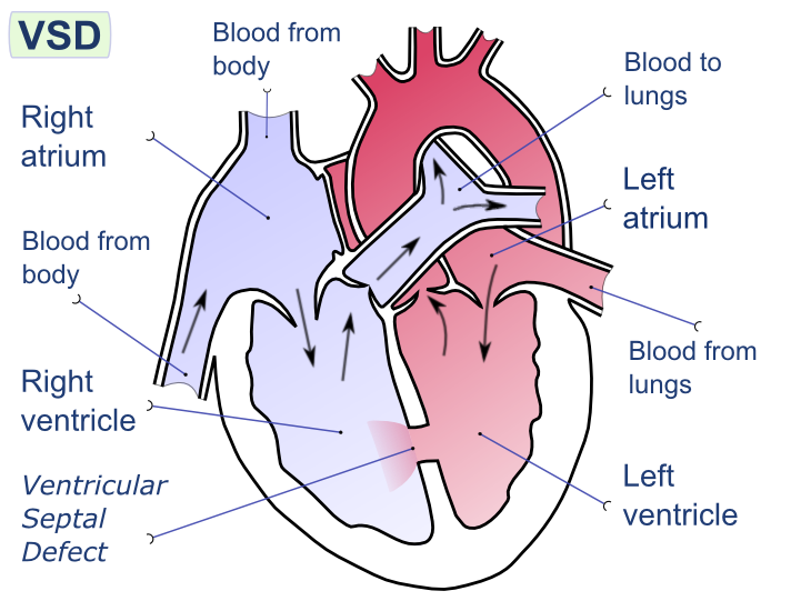 Ventricular septal defect (VSD). Illustration of heart with labeled atrium, ventricles, valves and arteries.