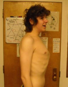 photo of someone with pectus carinatum. His chest protrudes further than normal.