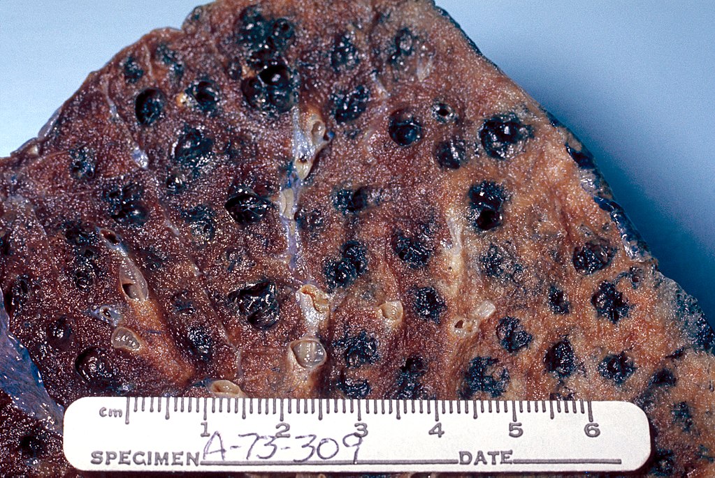 A section of a deceased person's lung that shows severe emphysema. The black "bubbles" are emphysemous alveoli that have expanded and become filed with black carbon that is from smoking