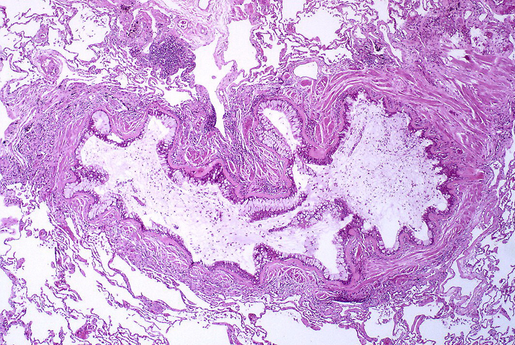 Microscopic image shows obstruction of the lumen of the bronchiole by mucoid exudate, goblet cell metaplasia, epithelial basement membrane thickening and severe inflammation of bronchiole.