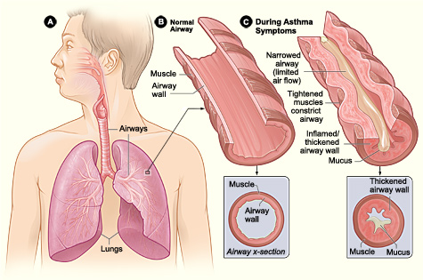 Asthma attack: illustration with normal airway, and airway during asthma attack.