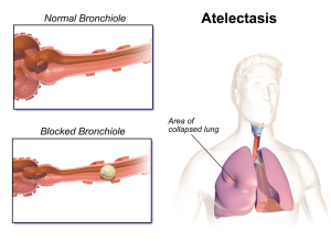an illustration of atelectasis. it shows normal bronchiole and blocked bronchiole in the area of the collapsed lung.