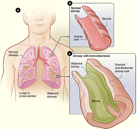 illustration of A: the lungs, B: tube-like normal airway, C: airway with bronchiectasis shows mucus in the airway.
