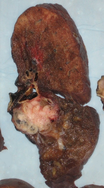 Gross appearance of the cut surface of a pneumonectomy specimen containing a lung cancer, here a Squamous cell carcinoma (the whitish tumor near the bronchi).
