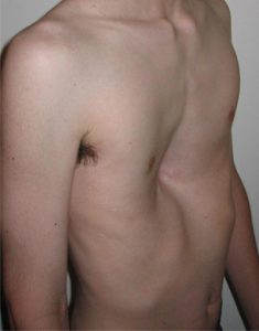 Photo of someone with Pectus excavatum (Funnel chest): a depression of the sternum and chest