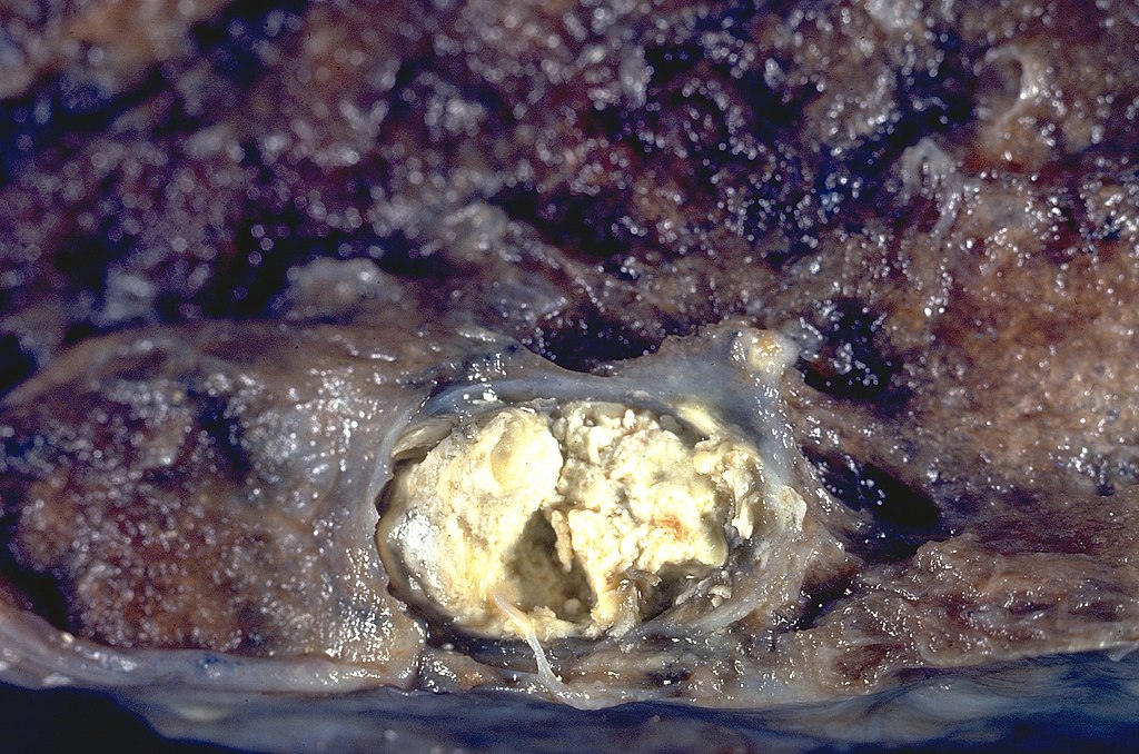 An image of a lung with tuberculosis