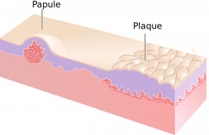 Image depicts papule and plaque. Note depth of lesions and larger surface area of plaque.