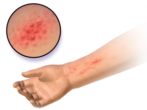 Contact allergic dermatitis on the anterior forearm, shown as red, bumpy skin.