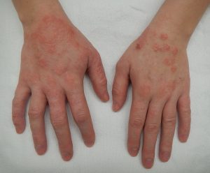 Moderately severe dermatitis in the hands