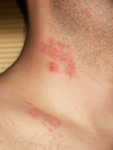Herpes zoster (shingles) on the neck, appearing as raised red vesicles