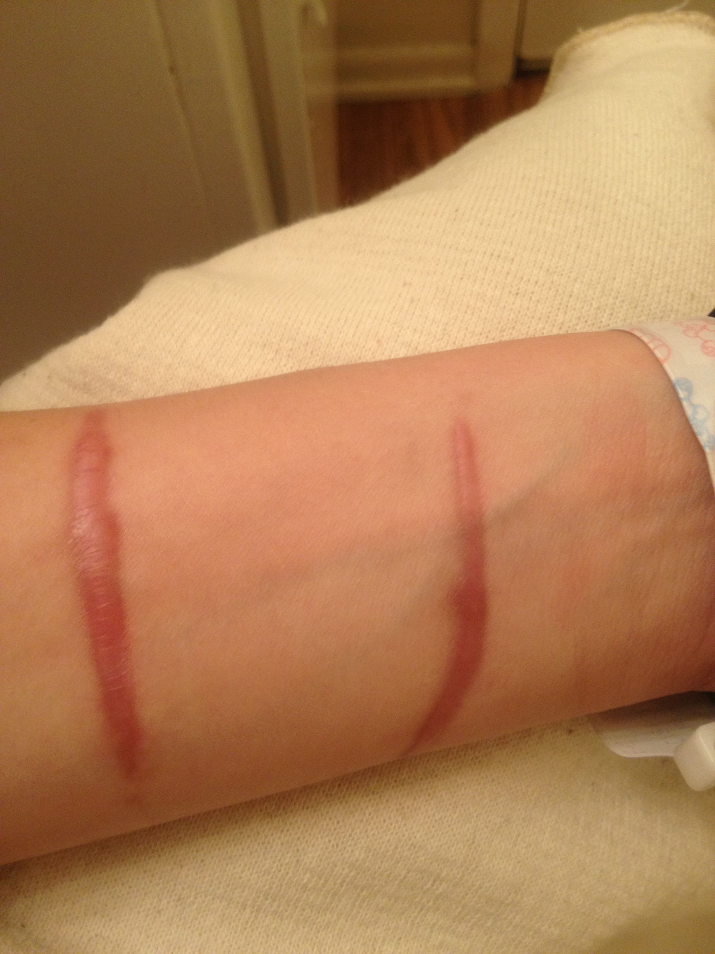 Hypertrophic scar -4 months after incident- 2013-04-05 00-46