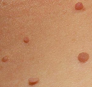 Skin tags (acrochordons) on the neck