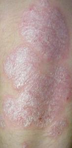 Psoriasis, showing silvery scales