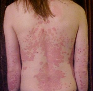 Psoriasis on the back