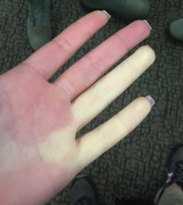 Raynaud phenomonon shown. Extreme whiteness of the 4th and 5th digits of the left hand.