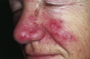 Rosacea. Erythema and telangiectasia are seen over the cheeks, nasolabial area and nose. Inflammatory papules and pustules can be observed over the nose. The absence of comedos is a helpful tool to distinguish rosacea from acne.