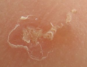 Close-up photo of a scabies burrow. The large scaly patch at the left is due to scratching. The scabies mite traveled toward the upper right and can be seen at the end of the burrow.