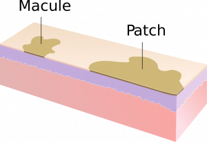 Image depicts a small macule and larger patch on the surface of the skin.