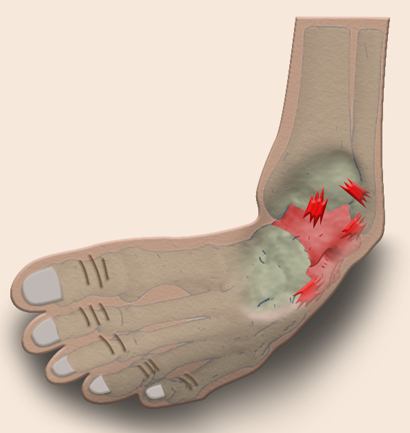 Illustration of a sprained ankle shows the ligaments and tendons that are torn.