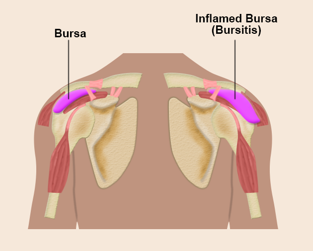 Illustration of a normal bursa and an inflamed bursa (bursitis).