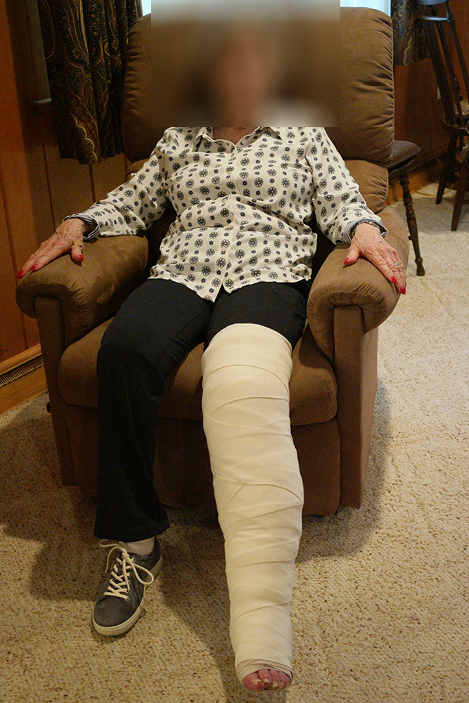 Photo of an elderly woman seated in chair with a cast on her leg.