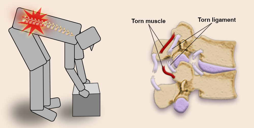 Illustration: a person bending over to lift a box hurts their back. 2 vertebrae show torn muscles and ligaments.