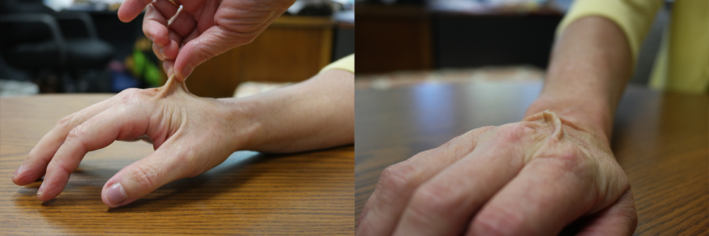 2 photos. 1. A hand pinches and pulls the skin on the back of a hand. 2. The skin stands by itself.