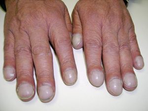 Photo showing a person's hands from the knuckle side, who has Cyanosis of the fingers