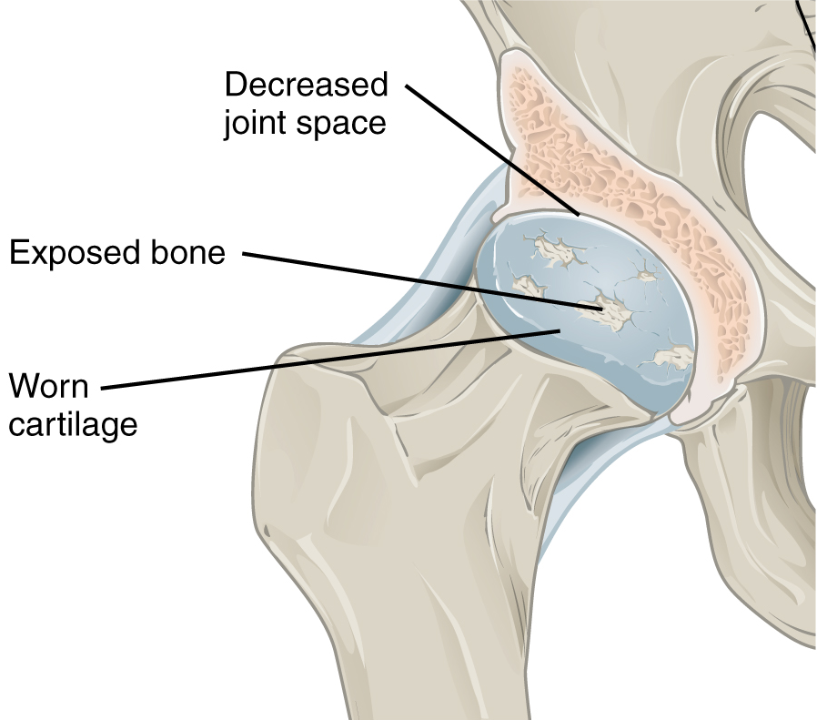 Diagram of OA in the hip joint with labels