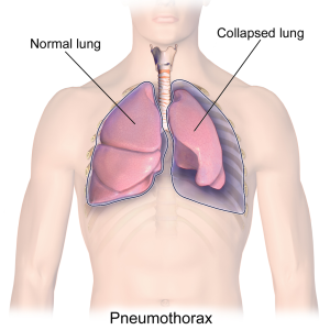 An illustration of atelectasis shows normal bronchiole and blocked bronchiole in the area of the collapsed lung.