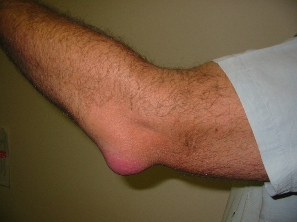 Photo shows swelling of Bursitis Elbow