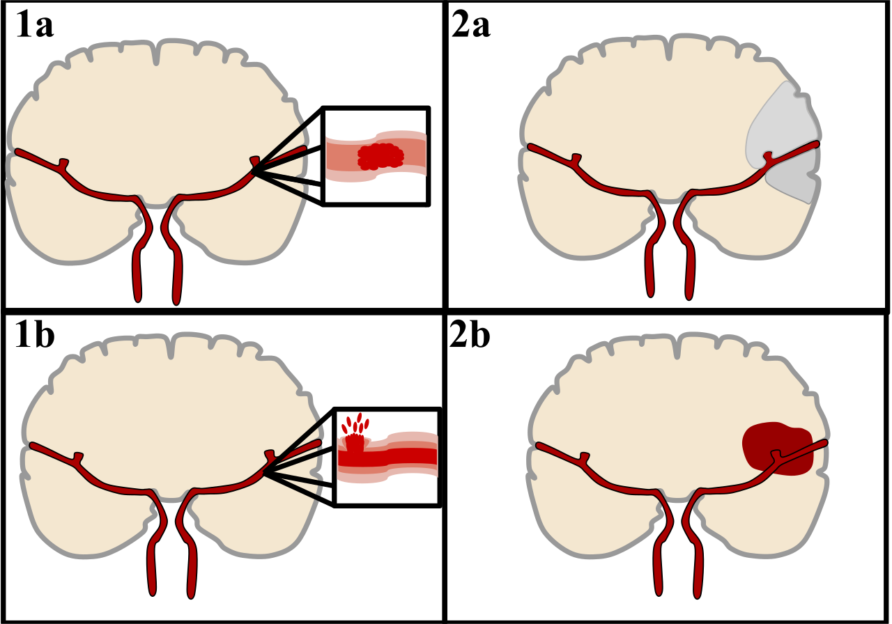 an illustration showing how the two main categories of strokes occur
