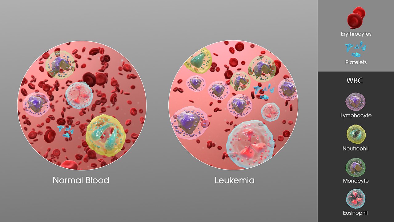 3D Medical Animation still showing an increase in white blood cells of a person suffering from Leukemia.