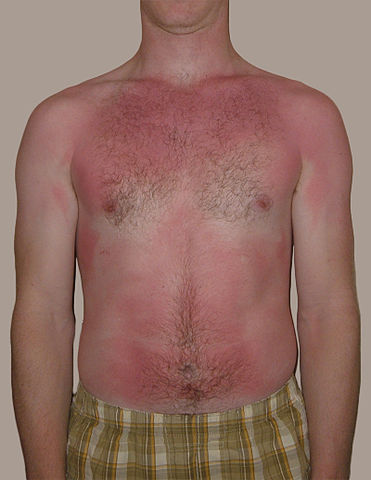 Superficial (first-degree) - Sunburn