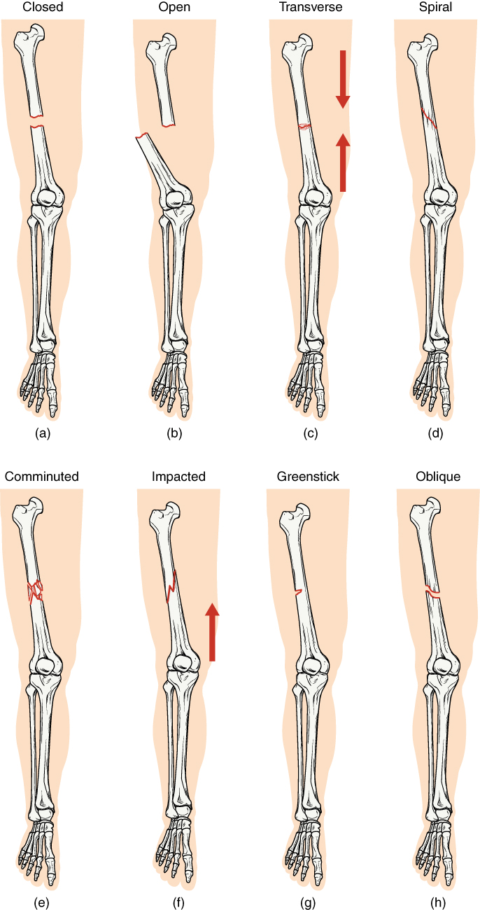 Eight illustrations of a broken femur: closed, open, transverse, spiral, comminuted, impacted, greenstick and oblique