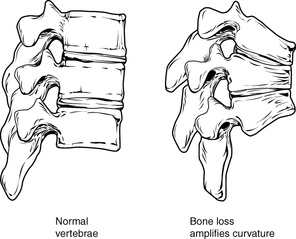 Feature: Osteoprosis of Spine: two illustrations, one of normal vertebrates, and one of vertebrates misshapen from osteoporosis.