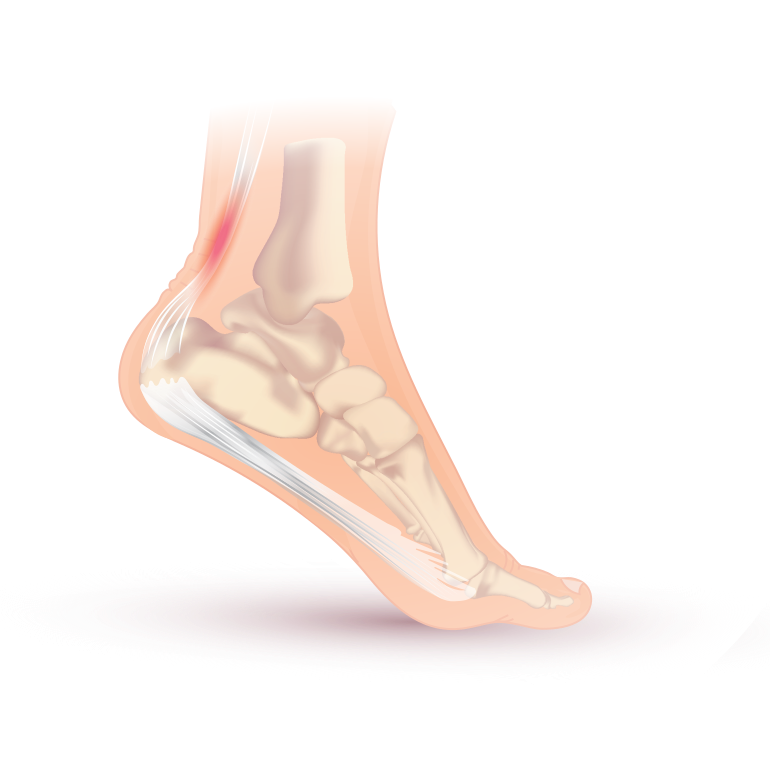 Illustration of Achilles tendonitis