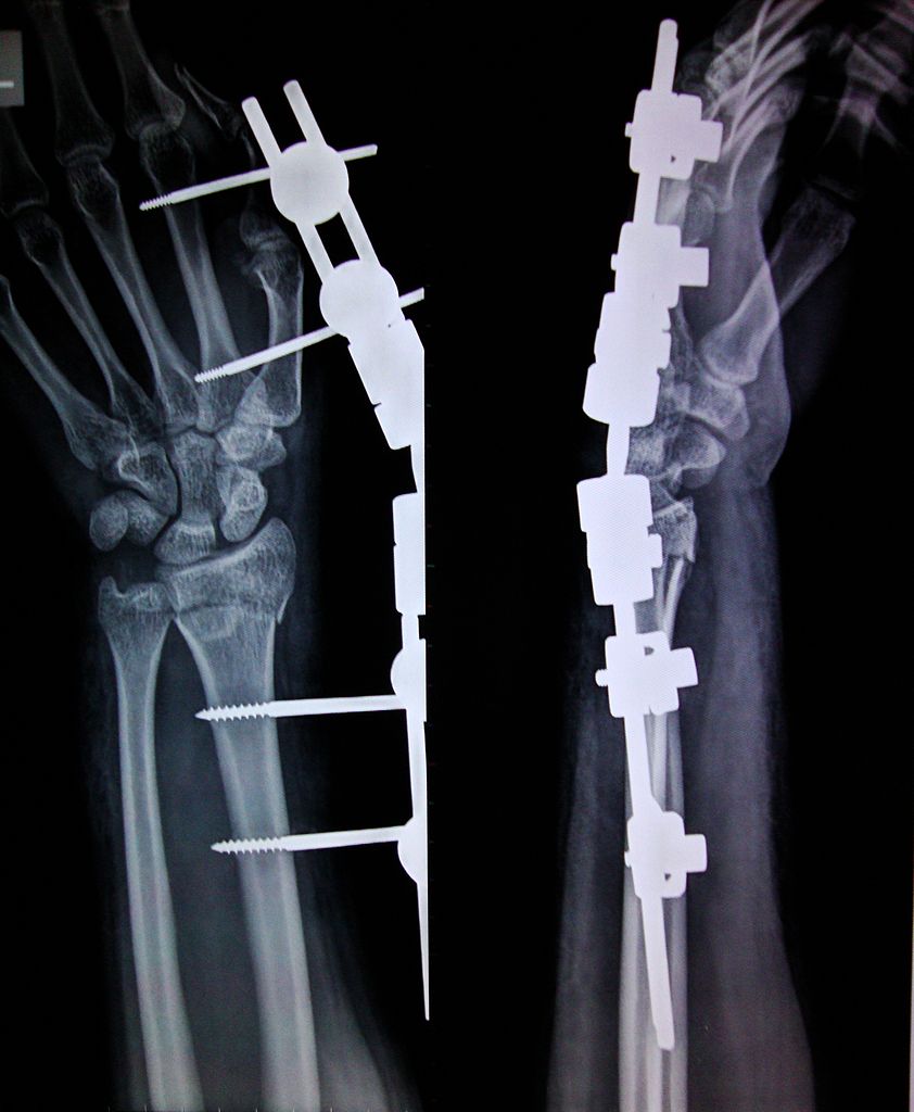 External Fixation in a forearm and hand shows metal screws and braces in the bones