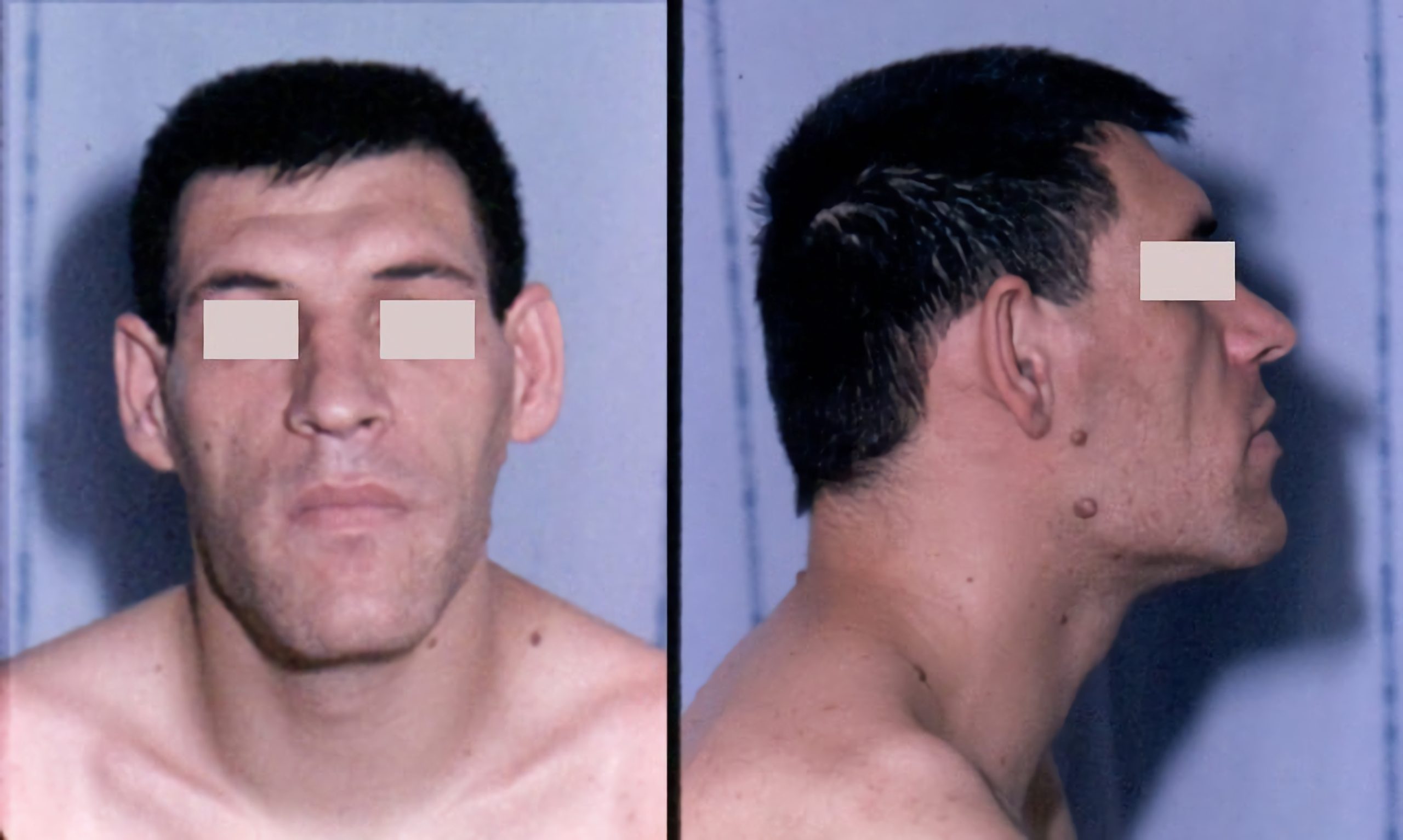 Acromegaly facial features