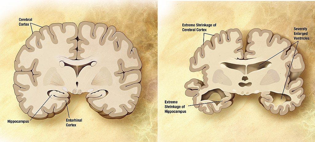 Illustrations of 2 cross sections of the brain, one normal, the other with Alzheimer's shows shrinkage.