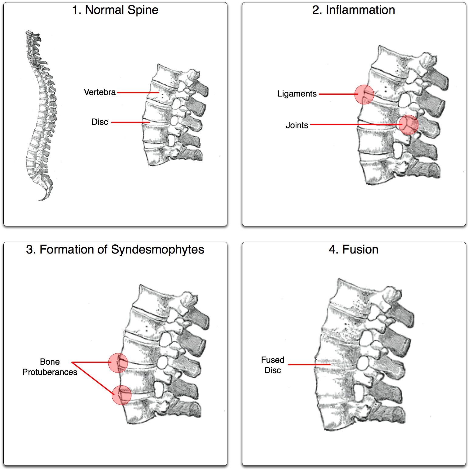 4 illustrations. 1. Normal spine. 2. Inflammation 3. Syndesmophytes 4. Fusion