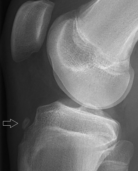 X-ray of Avulsion fracture of tibial tuberosity, annotated. Avulsion fracture of the tibial tuberosity in a 15-year-old male