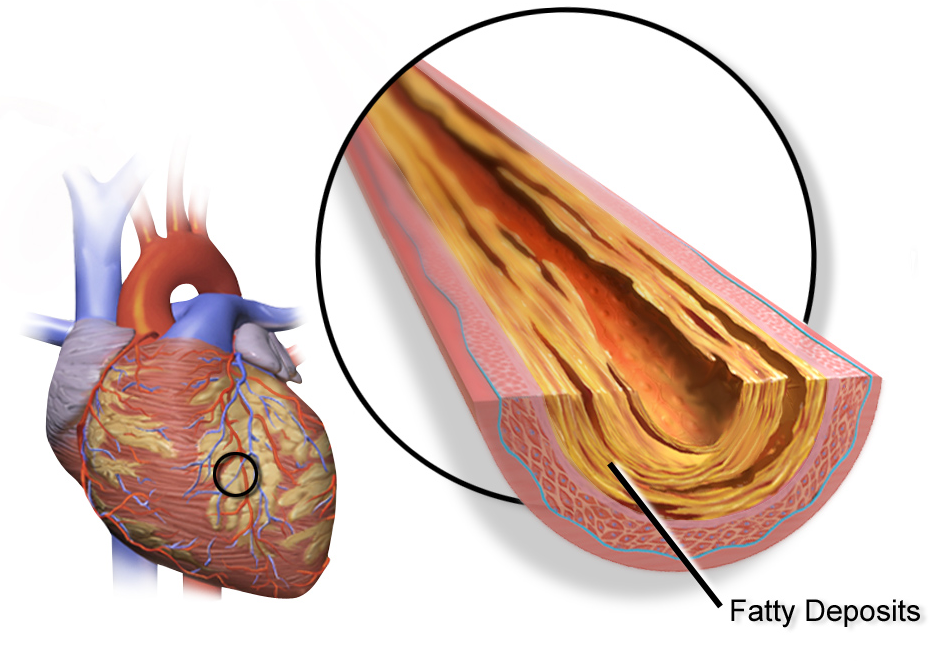 Illustration of the heart with zoomed view of an artery with fatty deposits