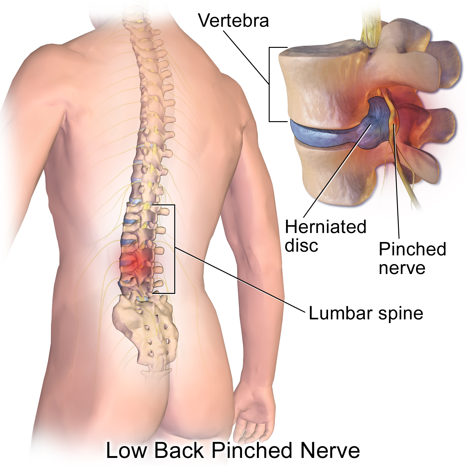 an illustration of a spine with a section magnified to show a herniated lumbar (pinched nerve in the lower back).