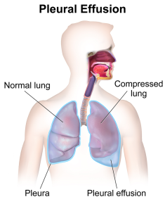 an illustration showing pleural effusion, with a normal lung, compressed lung, and Pleura.